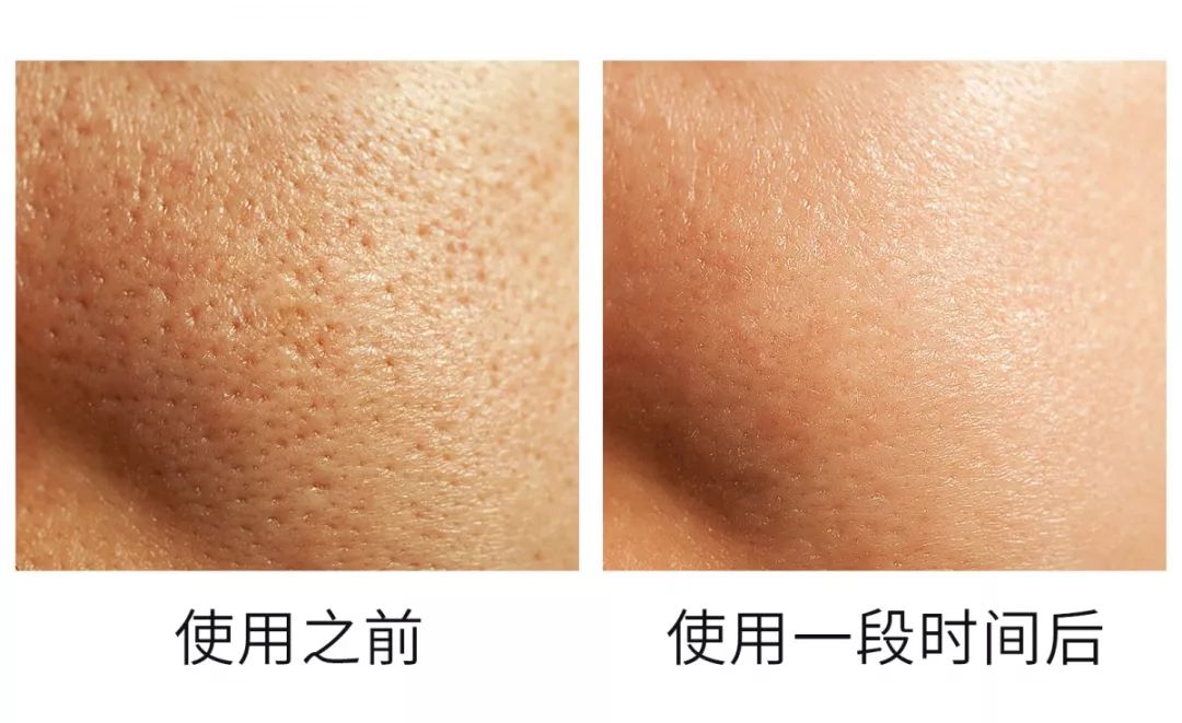 口碑炸裂洗面奶!油田脸∣痘痘肌的救星!植树澳洲茶树精油洗面奶(图11) 图片